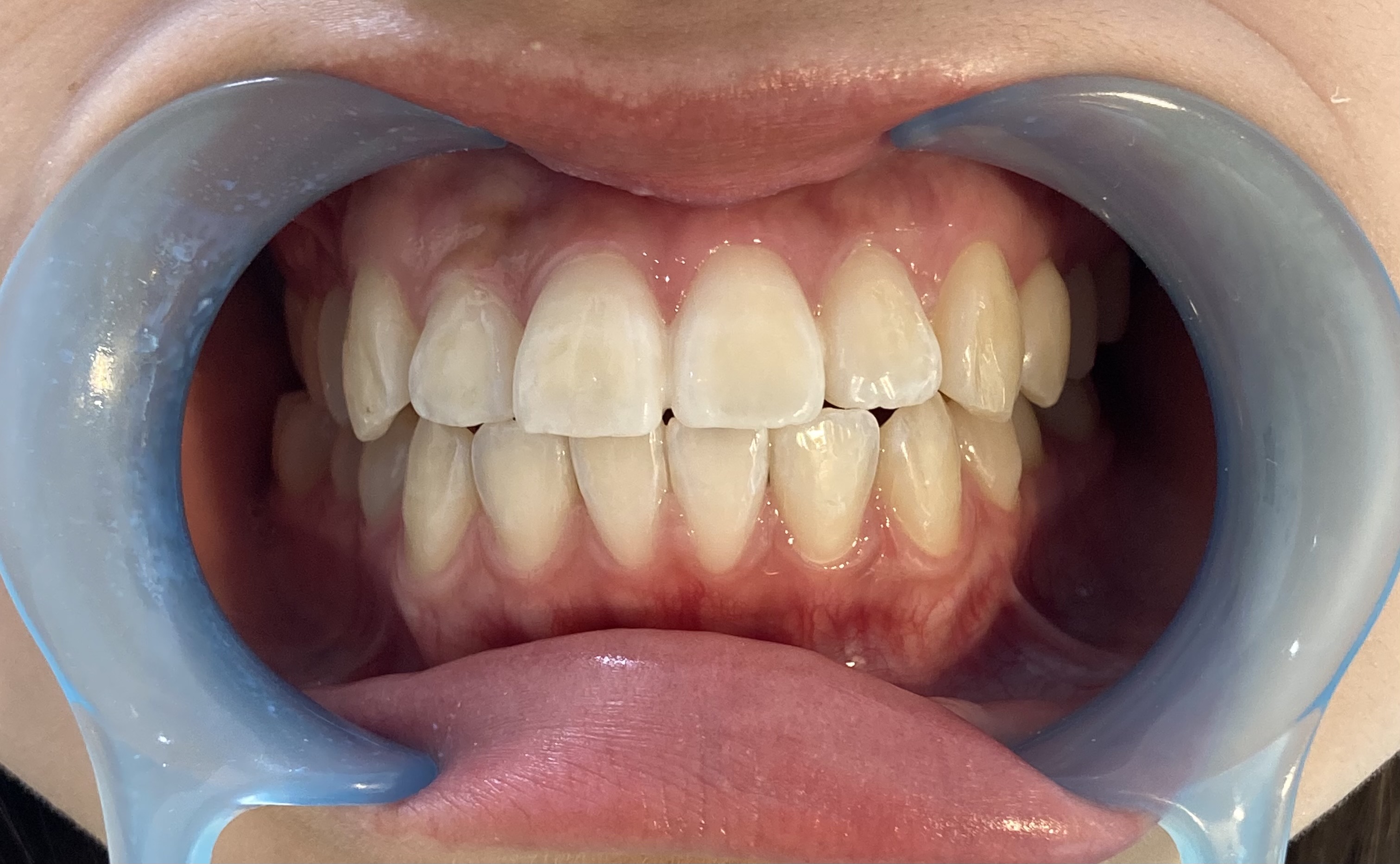 次世代セルフホワイトニング 美toothのセルフホワイトニング例1