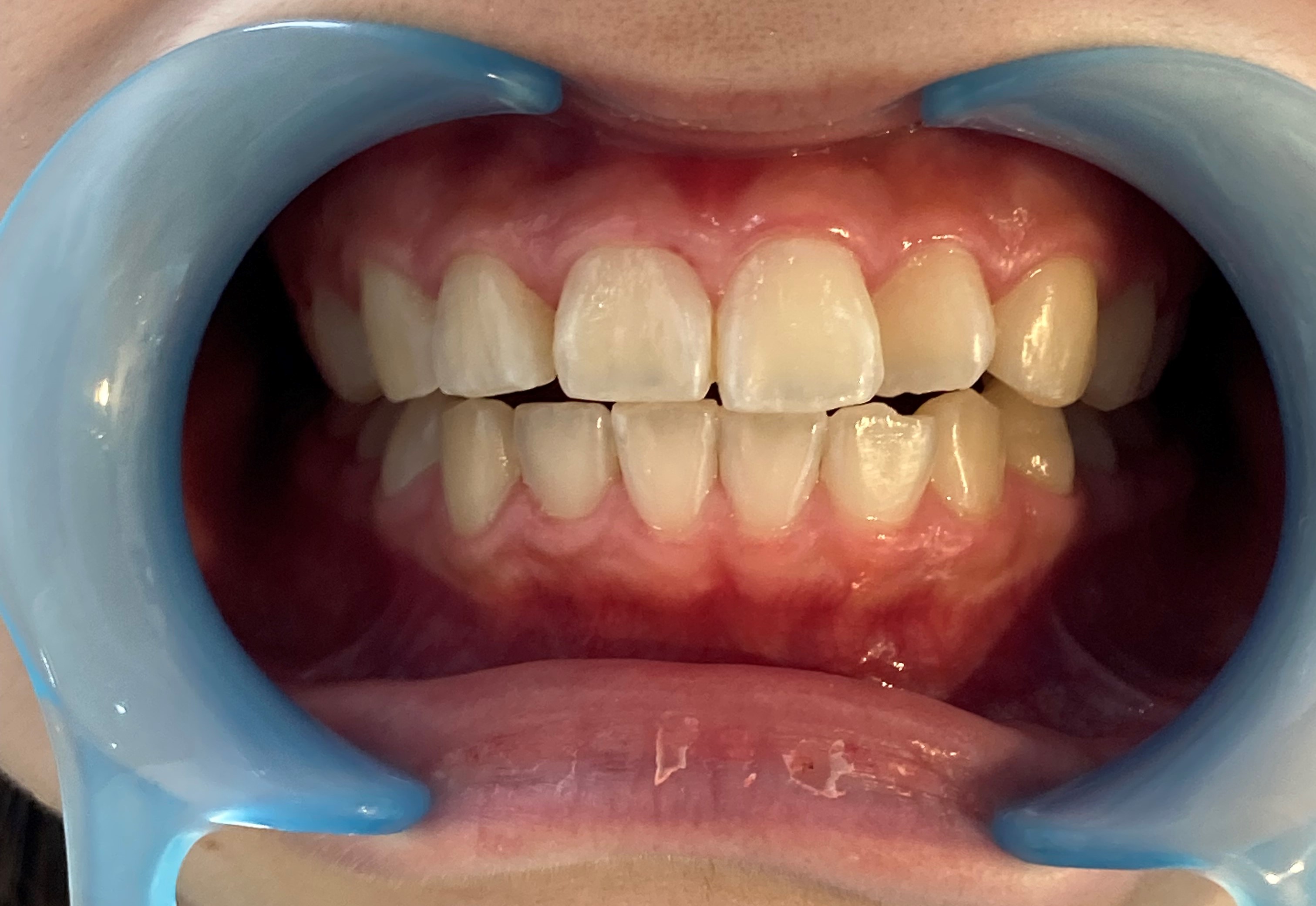 次世代セルフホワイトニング 美toothのセルフホワイトニング例2
