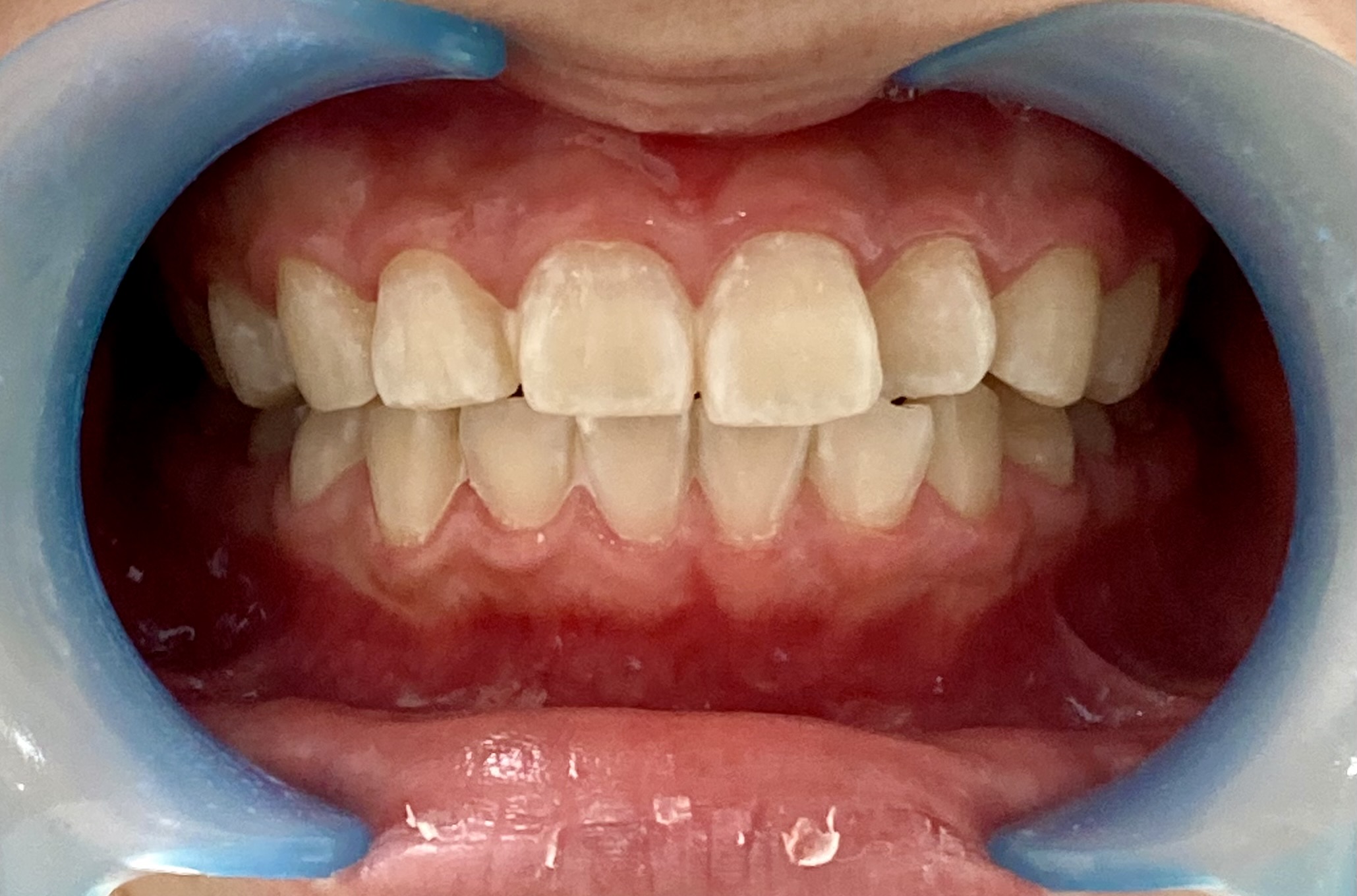 次世代セルフホワイトニング 美toothのセルフホワイトニング例2