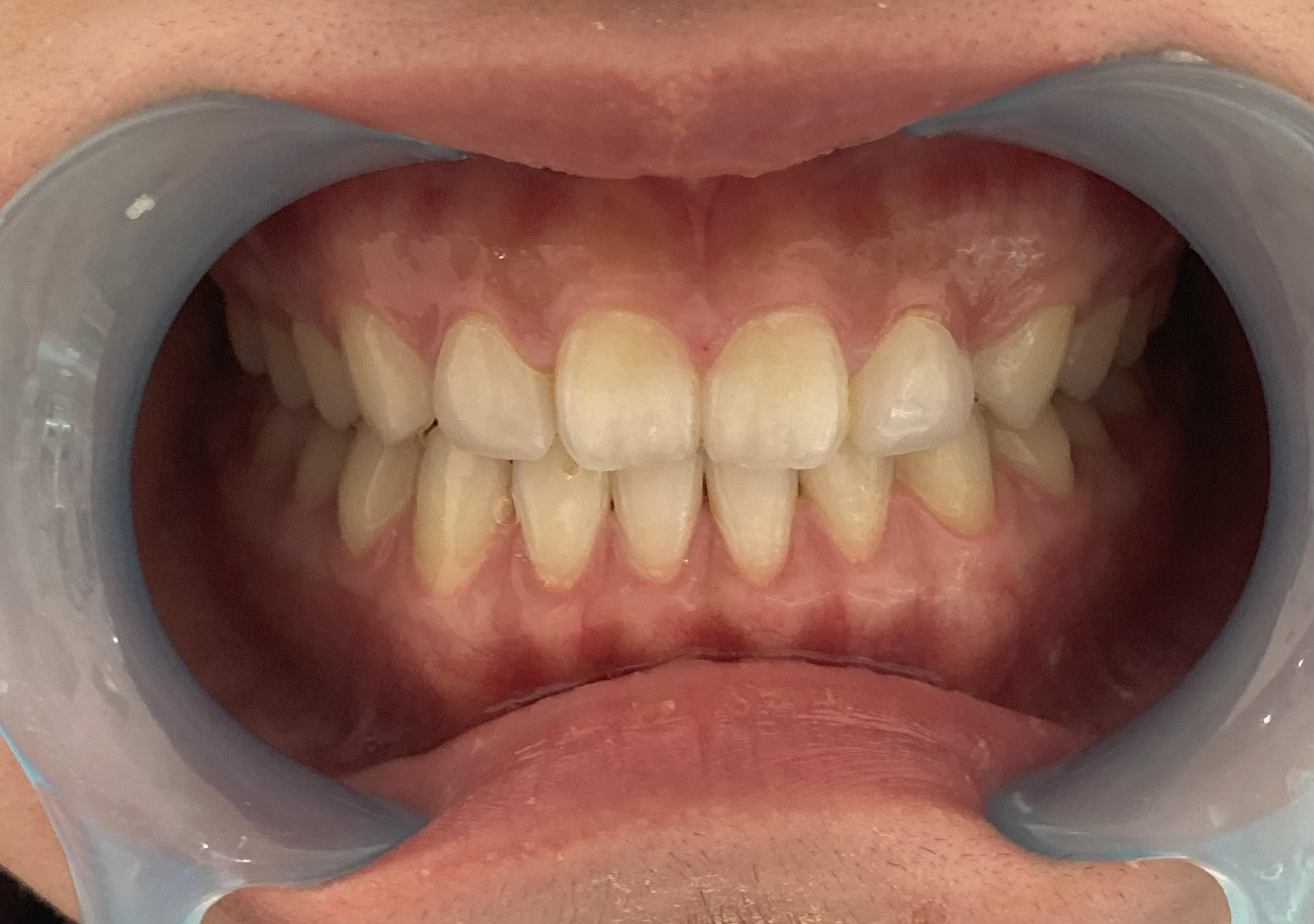 次世代セルフホワイトニング 美toothのセルフホワイトニング例3