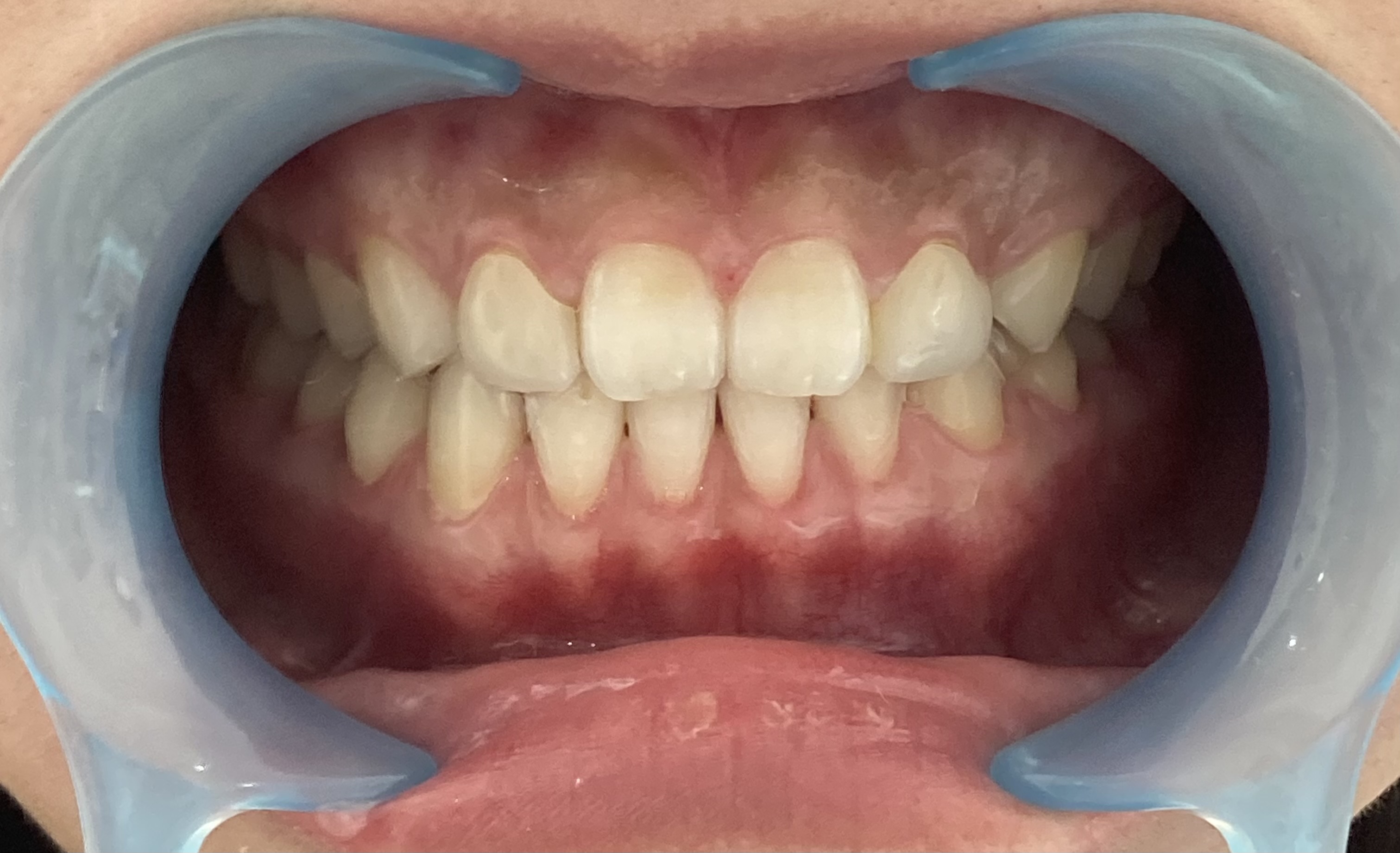 次世代セルフホワイトニング 美toothのセルフホワイトニング例3