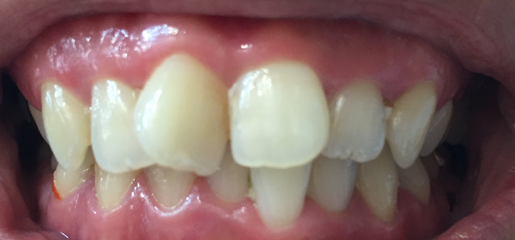 歯のホワイトニングサロン Teeth Cleanのセルフホワイトニング例1
