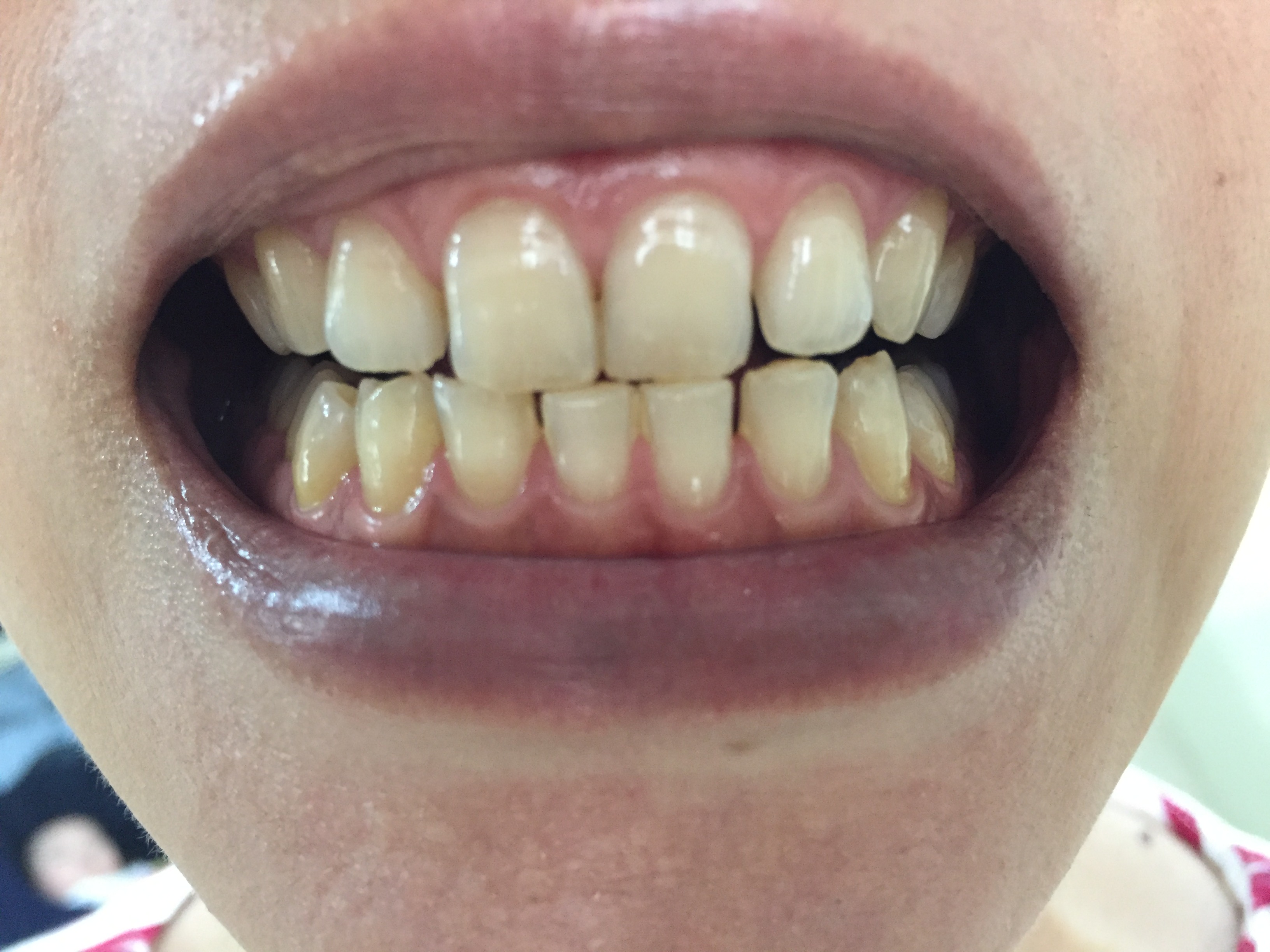 歯のホワイトニングサロン Teeth Cleanのセルフホワイトニング例2
