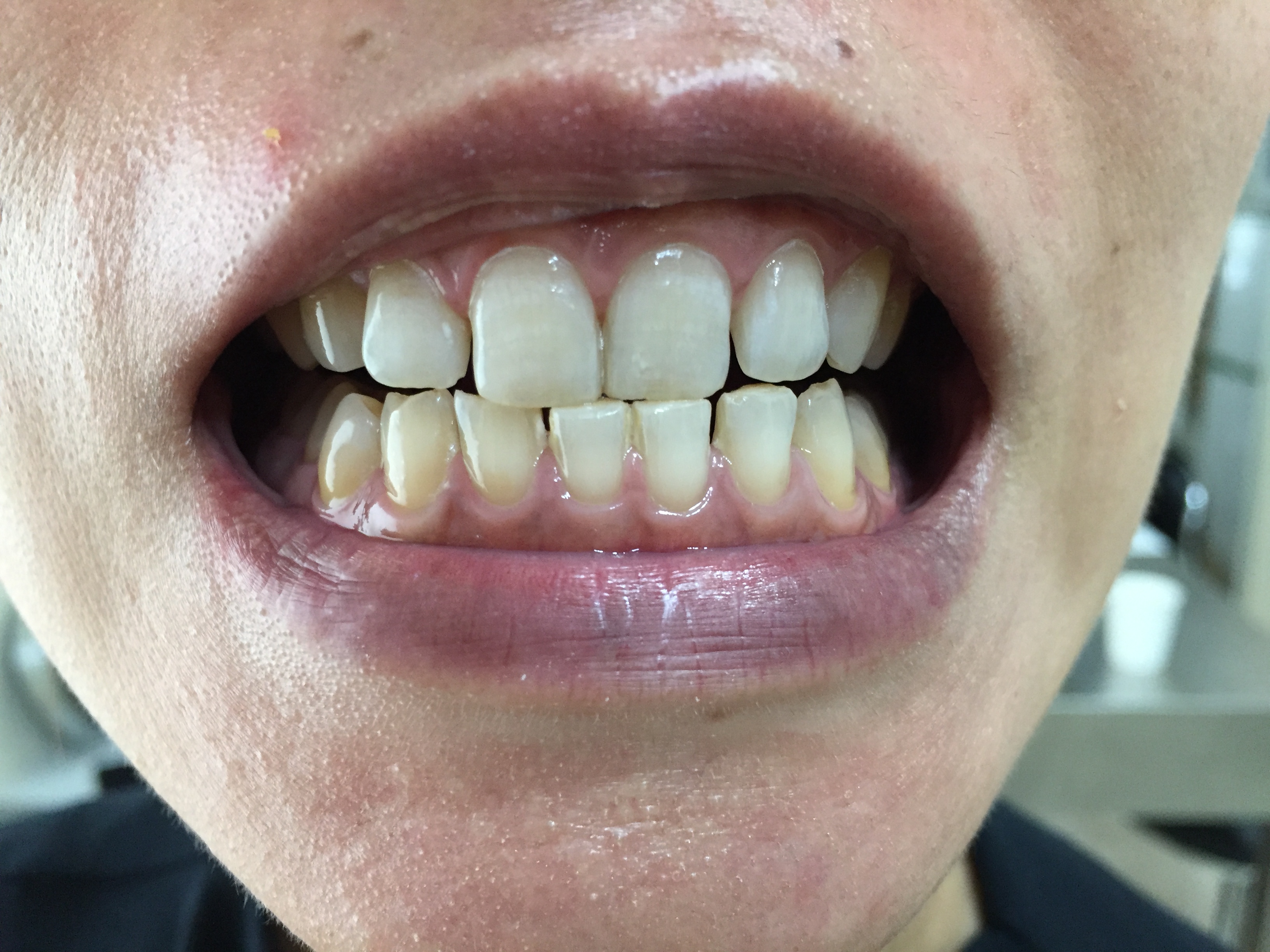 歯のホワイトニングサロン Teeth Cleanのセルフホワイトニング例2