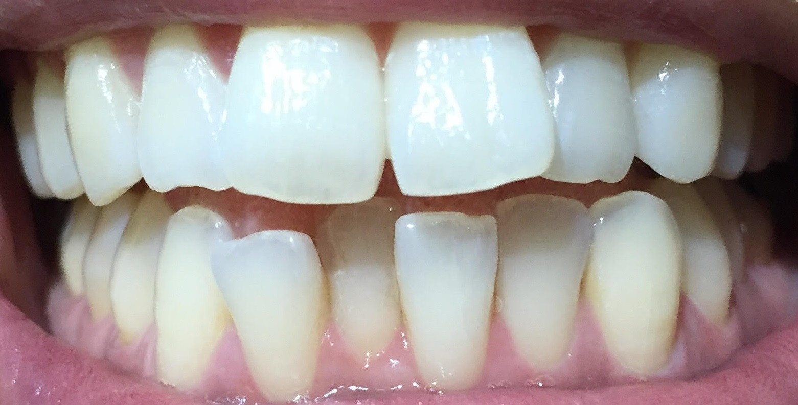 歯のホワイトニングサロン Teeth Cleanのセルフホワイトニング例3