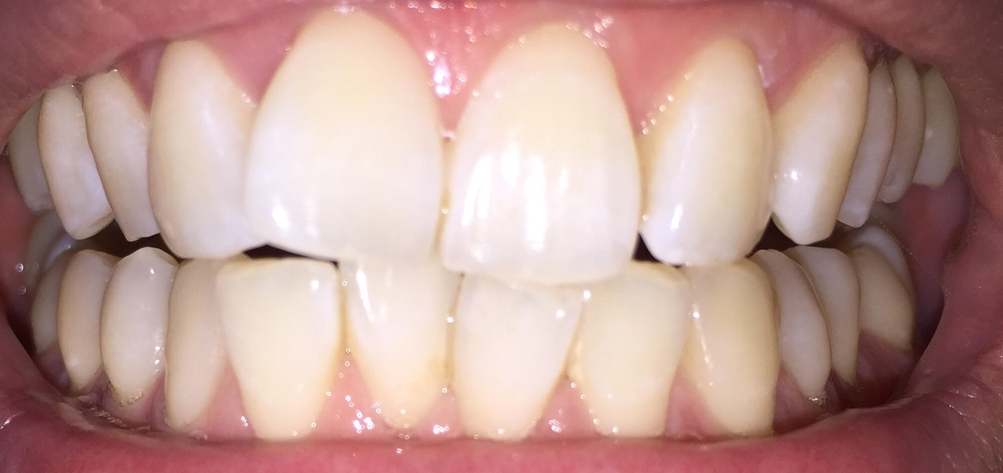 歯のホワイトニングサロン Teeth Cleanのセルフホワイトニング例4