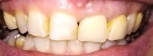 歯のホワイトニングサロン Teeth Cleanのセルフホワイトニング例5