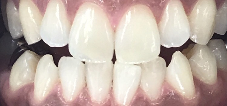 WaxSalon MAILE銀座のセルフホワイトニング例1