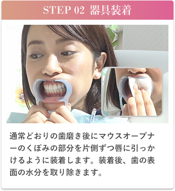 STEP02器具装着、通常通りの歯磨き後にマウスオープナーのくぼみの部分を片側ずつ唇に引っ掛けるように装着します。装着後、歯の表面の水分を取り除きます。